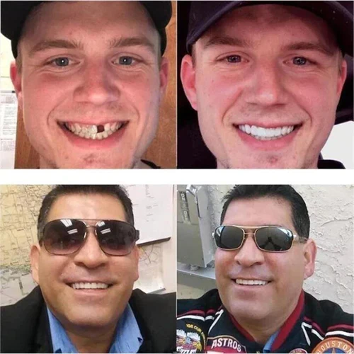 Snap-on veneers (Upper & Lower Set) ~ Instantly transform your smile with ease - Image 5