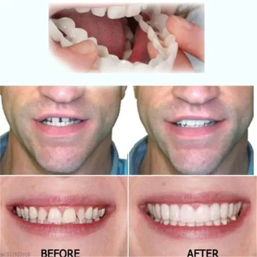 Snap-on veneers (Upper & Lower Set) ~ Instantly transform your smile with ease - Image 7